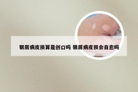 银屑病皮损算是创口吗 银屑病皮损会自愈吗