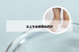 头上牛皮癣摸啥药好