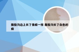 腹股沟边上长了像癣一样 腹股沟长了白色的癣