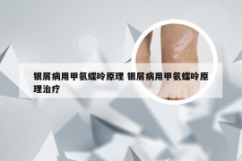 银屑病用甲氨蝶呤原理 银屑病用甲氨蝶呤原理治疗