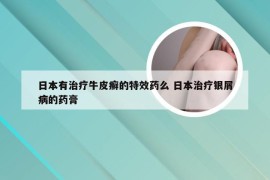 日本有治疗牛皮癣的特效药么 日本治疗银屑病的药膏