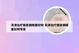 天津治疗银屑病哪里好啊 天津治疗银屑病哪里好啊专家