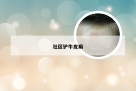 社区铲牛皮癣