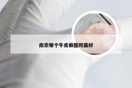 南京哪个牛皮癣医院最好