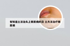 有知道土法治头上银屑病的没 土方法治疗银屑病