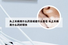 头上长癣用什么药膏或者什么香皂 头上长癣用什么药好得快