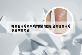 哪里有治疗银屑病的最好医院 全国哪里治疗银屑病最专业