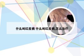 什么叫红皮病 什么叫红皮病,怎么治疗