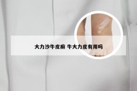 大力沙牛皮癣 牛大力皮有用吗