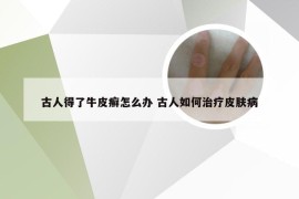 古人得了牛皮癣怎么办 古人如何治疗皮肤病