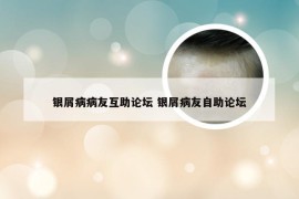 银屑病病友互助论坛 银屑病友自助论坛