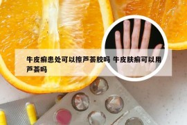 牛皮癣患处可以擦芦荟胶吗 牛皮肤癣可以用芦荟吗