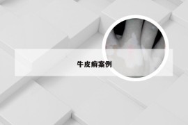 牛皮癣案例