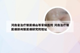 河南省治疗银屑病山等家橘医院 河南治疗银屑病郑州银屑病研究院地址