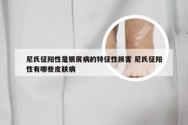 尼氏征阳性是银屑病的特征性损害 尼氏征阳性有哪些皮肤病