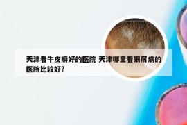 天津看牛皮癣好的医院 天津哪里看银屑病的医院比较好?