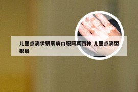 儿童点滴状银屑病口服阿莫西林 儿童点滴型银屑
