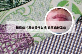 银屑病并发症是什么病 银屑病伴发病