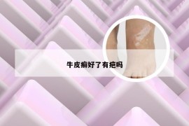 牛皮癣好了有疤吗