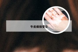 牛皮癣接受它