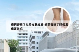 癣药膏用了以后皮肤红肿 癣药膏擦了轻微发痒正常吗