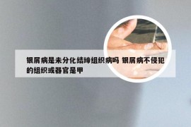 银屑病是未分化结缔组织病吗 银屑病不侵犯的组织或器官是甲