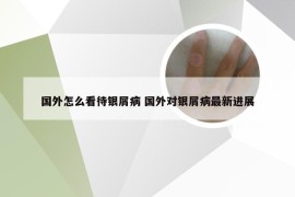 国外怎么看待银屑病 国外对银屑病最新进展
