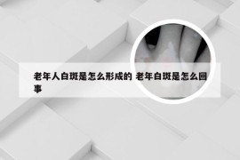 老年人白斑是怎么形成的 老年白斑是怎么回事