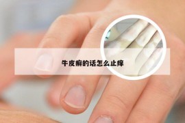 牛皮癣的话怎么止痒