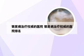银屑病治疗权威的医院 银屑病治疗权威的医院排名