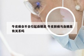 牛皮癣会不会引起血糖高 牛皮肤癣与血糖高有关系吗