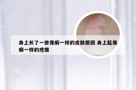 身上长了一些像癣一样的皮肤原因 身上起像癣一样的疙瘩