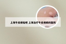 上海牛皮癣贴吧 上海治疗牛皮病癣的医院