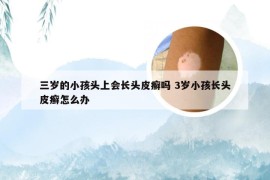 三岁的小孩头上会长头皮癣吗 3岁小孩长头皮癣怎么办