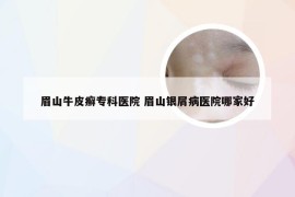 眉山牛皮癣专科医院 眉山银屑病医院哪家好