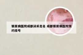 银屑病医院成都润禾出名 成都银屑病医院预约挂号