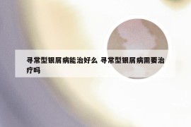 寻常型银屑病能治好么 寻常型银屑病需要治疗吗