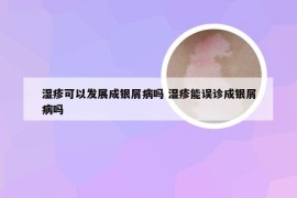 湿疹可以发展成银屑病吗 湿疹能误诊成银屑病吗