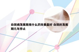 白斑病发展期用什么药效果最好 白斑的发展期几年停止