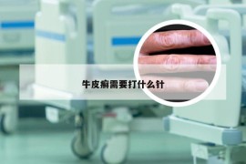牛皮癣需要打什么针