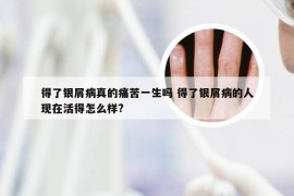 得了银屑病真的痛苦一生吗 得了银屑病的人现在活得怎么样?