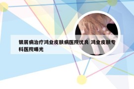 银屑病治疗鸿业皮肤病医院优良 鸿业皮肤专科医院曝光