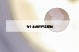 有牛皮癣还经常便秘
