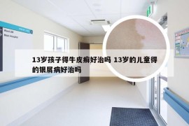 13岁孩子得牛皮癣好治吗 13岁的儿童得的银屑病好治吗