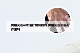 黄柏洗液可以治疗银屑病吗 黄柏洗液有消炎作用吗