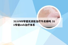 311UVB窄谱光波能治疗牛皮癣吗 311窄谱uvb治疗体系