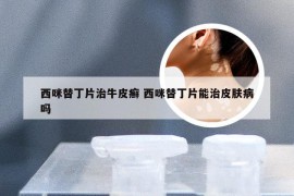 西咪替丁片治牛皮癣 西咪替丁片能治皮肤病吗