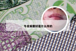 牛皮癣要好是什么样的