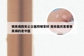 银屑病西安公立医院哪家好 西安最厉害看银屑病的老中医