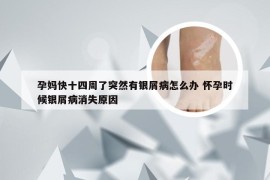 孕妈快十四周了突然有银屑病怎么办 怀孕时候银屑病消失原因